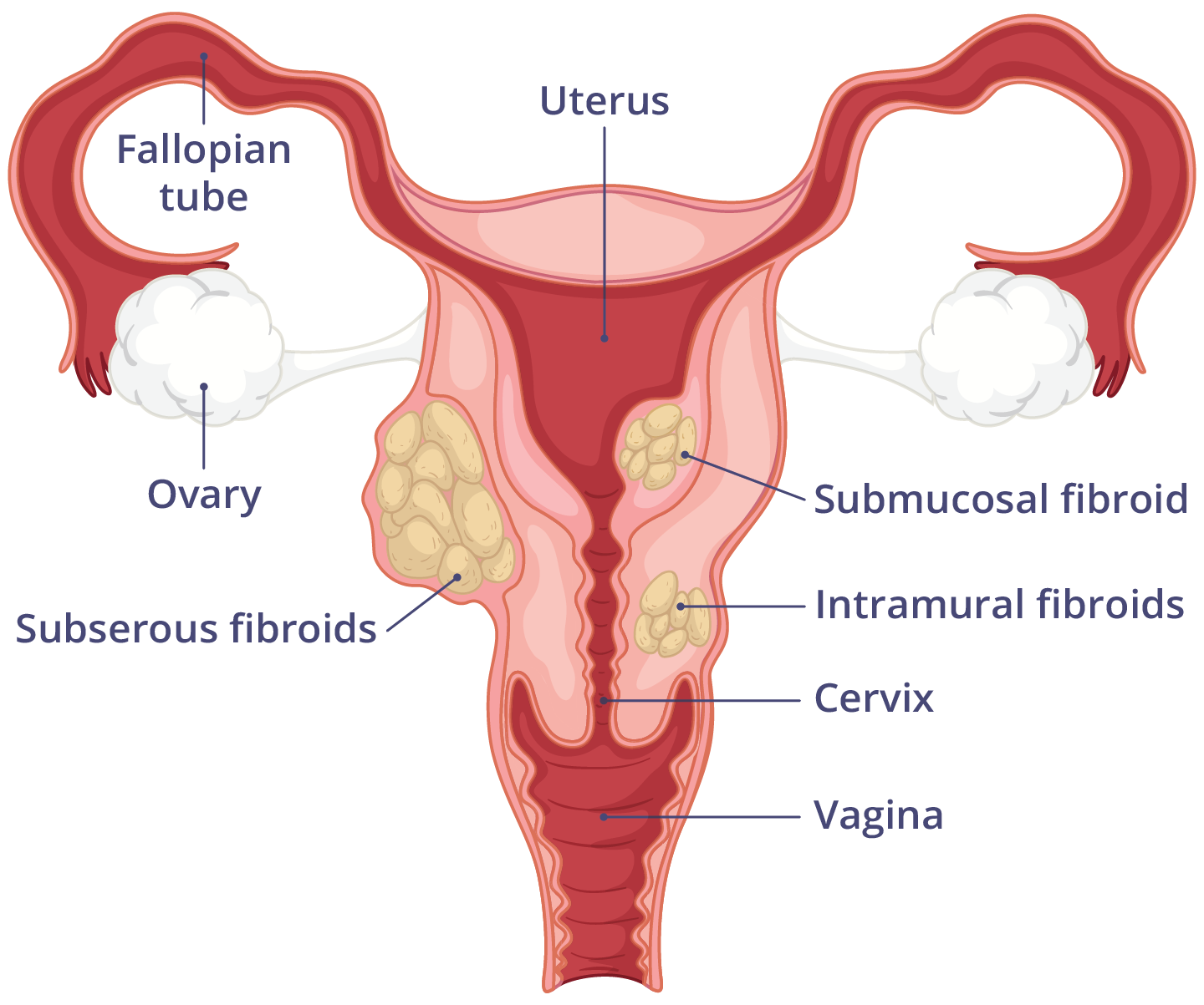 Illustration of the female reproductive system, with 3 different types of fibroid growths in the uterus and uterus muscle.